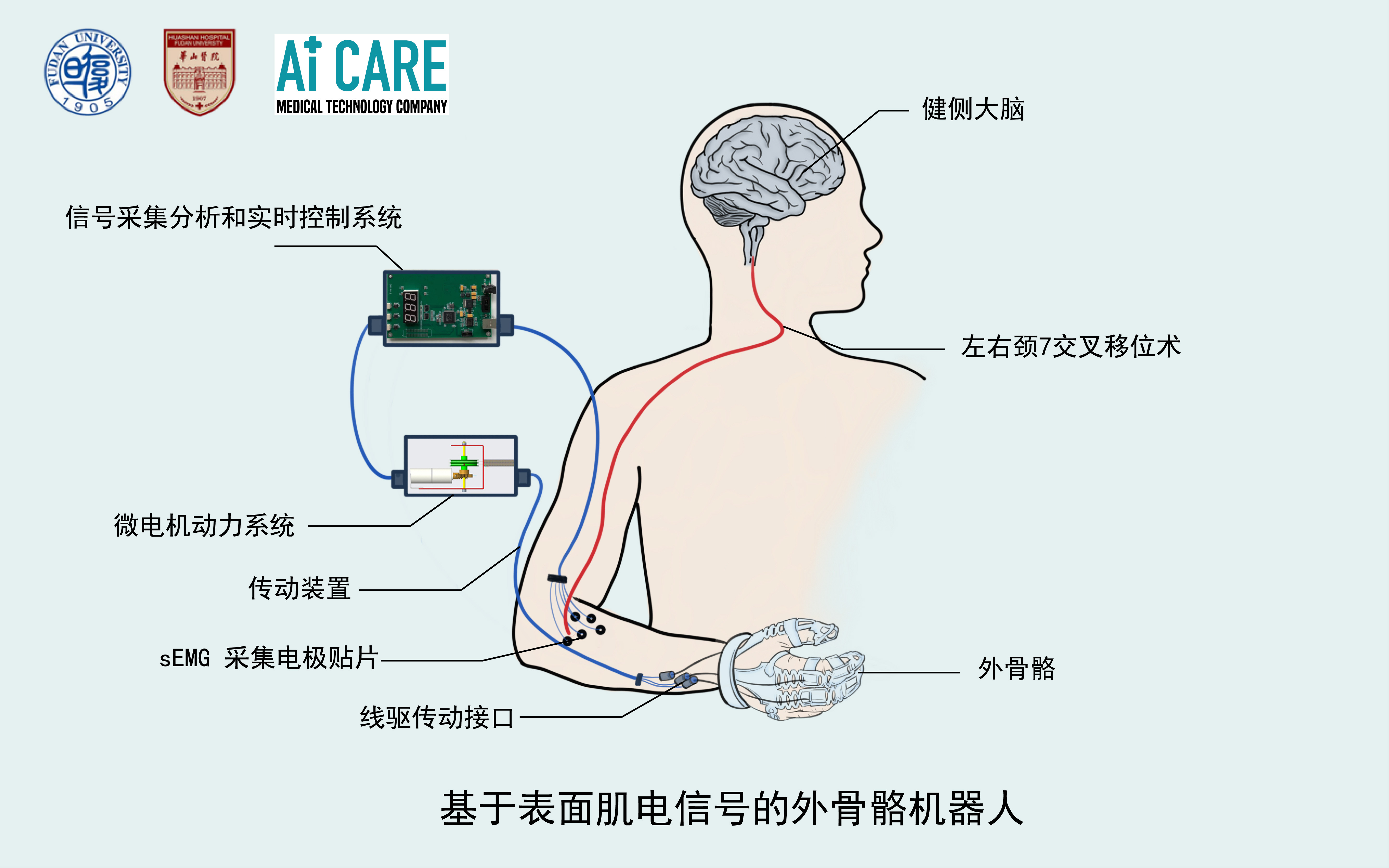 问鼎app官网下载安装 中风瘫痪手福音！普陀这家公司研发了一款会“读心”的智能手套，真正实现“手脑”相连