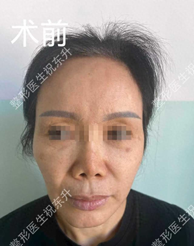 电波拉皮除皱做几次能除皱_退休金医美消费趋势分析_50+医美面部提升手术安全正规医院