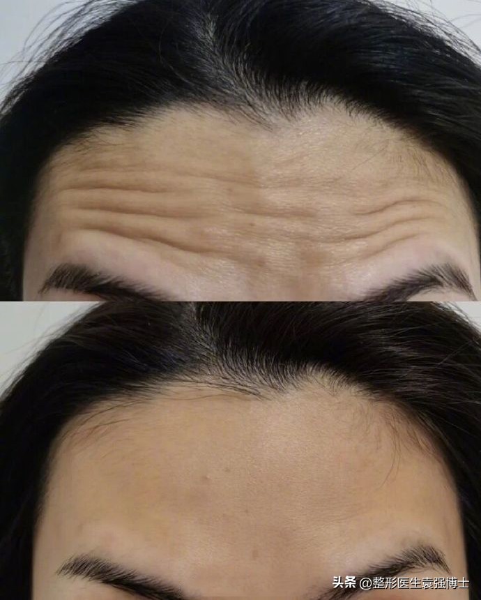 改善鱼尾纹_电波拉皮除皱做几次能除皱_改善抬头纹