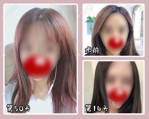 问鼎娱乐官网下载 花20000块钱做了大眼综合5项后眼睛真的变大了,但这价格贵吗?