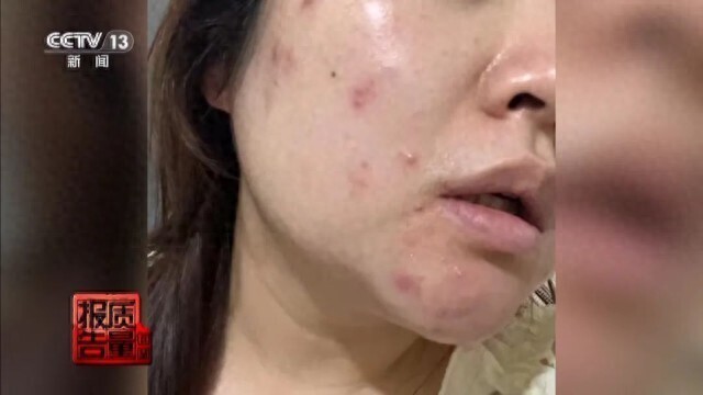 美容院祛痘_针清祛痘危害_美容院做脸部护理好吗