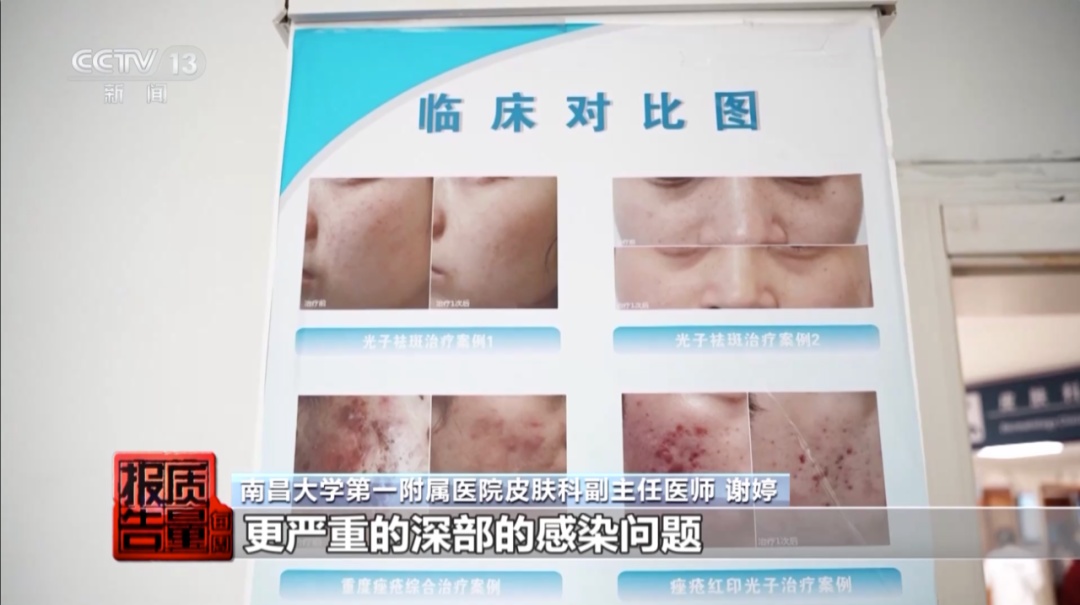 祛痘治疗无证操作_做面部清洁需要多少钱_美容院祛痘针清风险