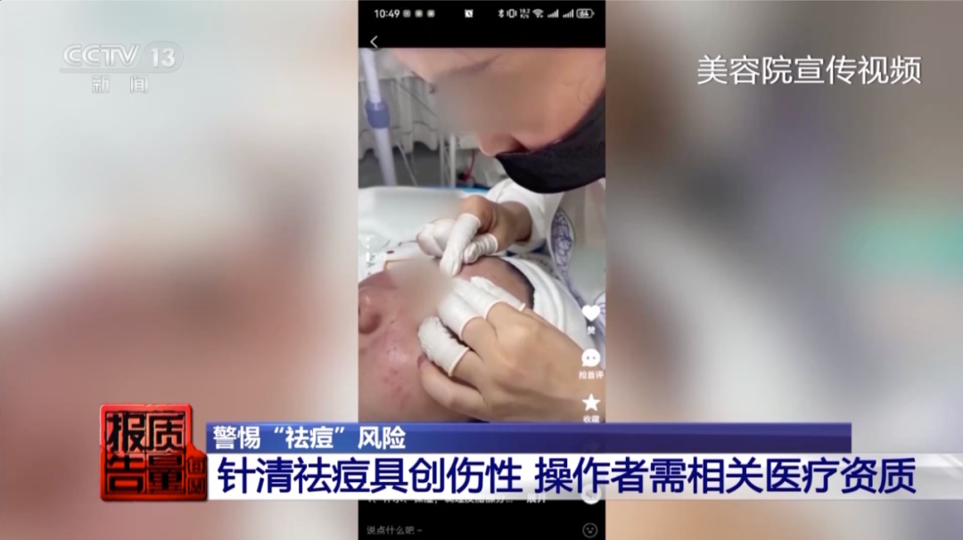 祛痘治疗无证操作_美容院祛痘针清风险_做面部清洁需要多少钱